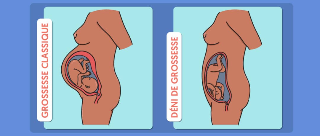 SANTE/DÉNI DE GROSSESSE : Mythe ou réalité en Afrique ?