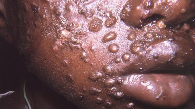 Zoonoses au Cameroun : La variole du singe, comment la comprendre et l'affronter ?