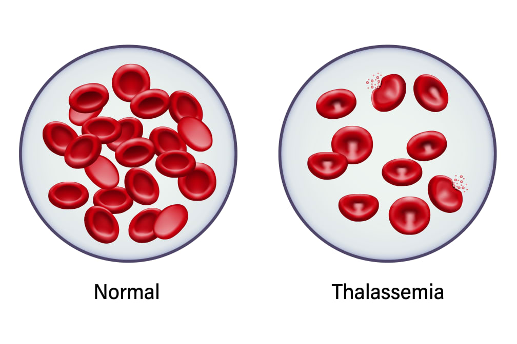 SANTÉ/Comprendre la thalassémie : une maladie génétique complexe.