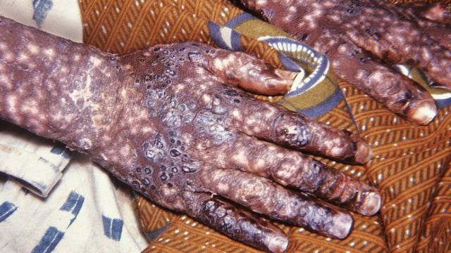 Prévention de la Monkey pox : une maladie virale émergente